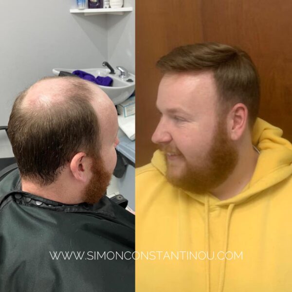 Men’s Hair Replacement Systems |Hair Loss Solutions at Simon ...